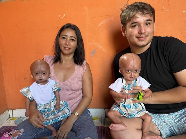 Gêmeas com síndrome do envelhecimento viram fenômeno na internet e  conquistam fãs: 'recebem muito amor' | G1