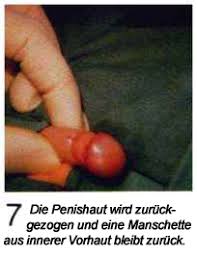 Wo befindet sich die vorhaut? Freihand Beschneidung Beschneidung Von Jungen