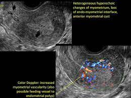 Adenomyosis Adenomyosis And Pregnancy Ivf1