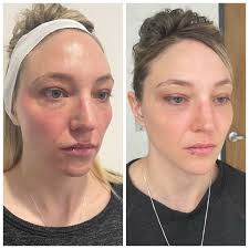 Sculptra in Denver, Boulder & Fort Collins