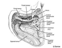 Trautmann's triangle is exposed with the black lined area. Surgical Approaches For Resection Of Acoustic Neuromas Barrow Neurological Institute
