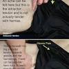 Differentiate the symptoms of a groin injury from other causes. 1