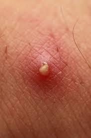 Common pimples should not concern you a great deal, if they resolve easily. Boil Vs Pimple How To Tell The Difference