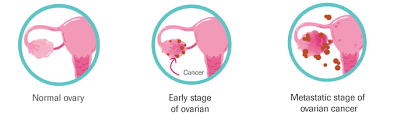 The mature teratoma is by far the. Ovarian Cancer