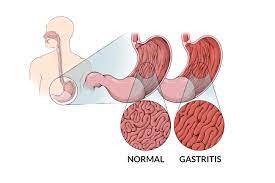 Vidio ini merupakan tugas praktek profesi keperawatan medikal bedah pada pasien dengan gangguan sistem pencernaan gastritis#pengkajiankeperawatan. Gastritis Gejala Penyebab Dan Mengobati Alodokter