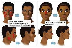 The ultimate male to female makeup program. Mid Third Face Modifications For Transgender Patients Left Ideal Male Download Scientific Diagram