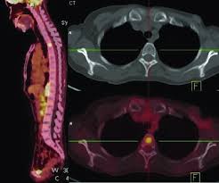 Often, a ct scan is done at the same time. Pet Ct Images Of A Patient With Breast Cancer Who Had Only One Bone Download Scientific Diagram