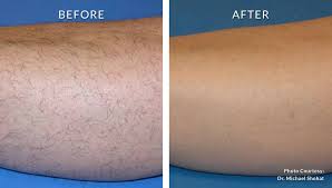 Laser hair removal, medical spas, body contouring. Laser Hair Removal