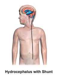 Image result for Hydrocephalus