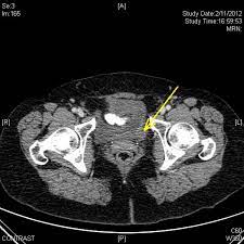 A computed tomography (ct or cat) scan allows doctors to see inside your body. Abdominal Ct Scan With Contrast Yellow Arrow Showing A 16 Mm Tumor In Download Scientific Diagram