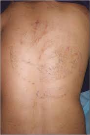 Does your permanent makeup look less attractive than you imagined? Mini Punch Skin Excision A Newer Novel Approach For Tattoo Removal Gupta J Chouhan K Kumar A Garg K J Cutan Aesthet Surg