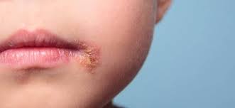 Image result for Impetigo
