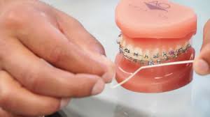 Rinse, and then check your teeth: Braces Brushing Braces Flossing How To Aura Orthodontics Youtube