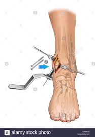 The lateral malleolus is the name given to the bone on the outside of the ankle joint. Medialer Malleolus Stockfotos Und Bilder Kaufen Alamy