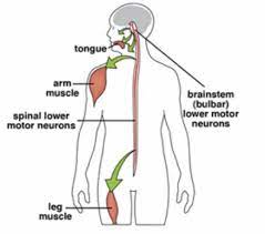 Pin By Podcastdx Llc On Motor Neuron Diseases Muscular Dystrophy Association Muscular Dystrophies Disease