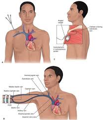 Central Lines Are Used To Administer Large Amounts Of Fluid Including Total Parenteral Nutrition Radiology Nursing Medications Nursing Central Venous Catheter