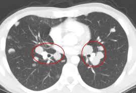 It is a heterogeneous disease with many clinically important subtypes2. How To Interpret Ct Scans Of Your Lung
