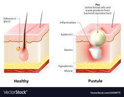 Types Of Acne Pimples