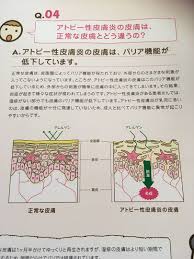 アトピー性皮膚炎の薬物療法 アトピー性皮膚炎 炎症 指示