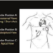 Rapid ultrasound for shock and hypotension. Pdf Bedside Ultrasound In Resuscitation And The Rapid Ultrasound In Shock Protocol