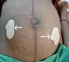 Image result for Nitroglycerin Patch