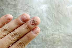 Water Damage On Nails