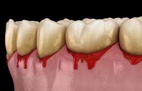 Image result for Periodontitis
