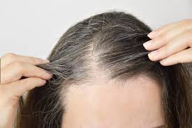 There are a lot of treatments out there that target male pattern baldness. Telogen Effluvium Hair Loss Treatment Clinic Nina Ross Atlanta Trichology