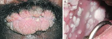 Image result for papillomavirus tongue)