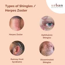 Image result for herpes zoster