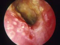 Image result for Acute Otitis Externa