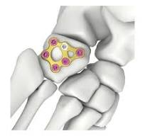 Foot &Ankle Fracture Plating System,Metatarsal/ Calcaneal ...