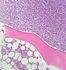 Bone Marrow Biopsy Multiple Myeloma Myeloma Multiple Myeloma Bone Marrow
