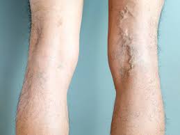 Ipl filters out any light in the uv range, so. Laser Hair Removal Side Effects And Risks