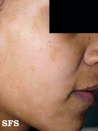 L41.0 pityriasis lichenoides et varioliformis acuta; Pityriasis Alba Wikidoc
