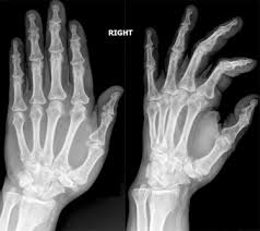 Ics of the tmc joint. Trapezium Bone Resection Arthroplasty And Suspension With Suture Button For The Treatment Of Trapeziometacarpal Osteoarthritis Long Term Follow Up In A Colombian Cohort Journal Of Hand Surgery Global Online