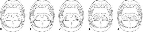 jcsm mallampati score and pediatric obstructive sleep apnea