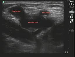 Pin By Tater Isamess On Ultrasound Vascular Echo Ultrasound Medical Ultrasound Diagnostic Medical Sonography