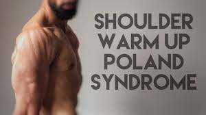 Check spelling or type a new query. Shoulder Warm Up Poland Syndrome Youtube