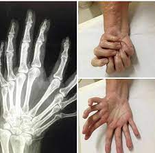 Mirror movements 1, also known as congenital mirror movement disorder, is related to kallmann syndrome and seckel syndrome. Arrs Mirror Hand Syndrome Is A Rare Congenital Anomaly Of The Upper Limb Which Can Lead To Some Very Uncommon Image Findings Facebook