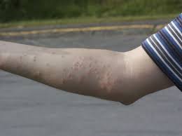 Image result for bedbugs bites