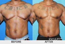 Bodybuilder Gynecomastia Causes And Treatments Xsculpt