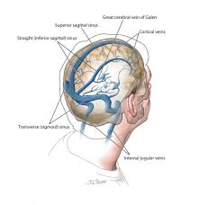 Anatomy Of Sinuses Brain Sinus Anatomy Human Anatomy Diagram Sinusitis Vein Thrombosis Thrombosis