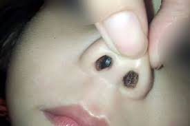 Penyebab ingus berdarah adalah karena pecahnya pembuluh darah di hidung. Gadis Kecil Ini Alami Demam Sebulan Penuh Setelah Diperiksa Ternyata Ada Benda Asing Di Hidungnya Semua Halaman Grid Health