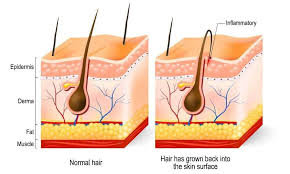 An ingrown hair occurs when the hair strand grows downward instead of upward and becomes trapped under the skin. Ingrown Beard Hairs Prevention Proven Remedies Guide