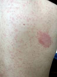 Online healthcare providers can help with skin rash. Prolonged Dermatological Manifestation 4 Weeks Following Recovery Of Covid 19 In A Child Bmj Case Reports