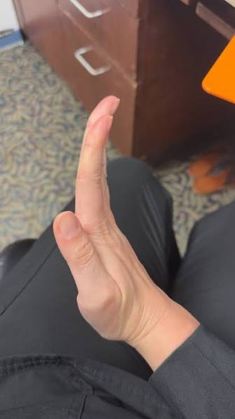 Can others with hEDS bend their thumbs and fingers in unusual ways?
