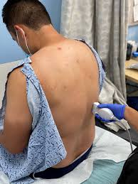 Image result for Thoracentesis