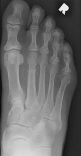 Image result for Metatarsal