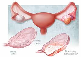 Primary ovarian, fallopian tube or primary peritoneal cancer with a ureteral stent in place. Mayo Clinic On Twitter Worldovariancancerday Is Encouraging Women To Look For Early Symptoms Of Ovariancancer Https T Co Ssiywsha8s Wocd Https T Co Z6kedh8rbx